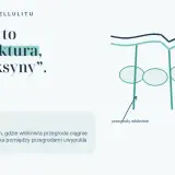 Mechanizm cellulitu: włókniste przegrody ciągną skórę, tworząc nierówności. Zrozumienie tego pomoże Ci jak pozbyć się cellulitu.