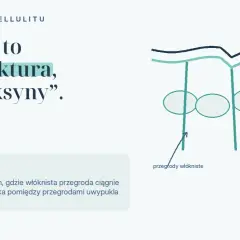 Mechanizm cellulitu: włókniste przegrody ciągną skórę, tworząc nierówności. Zrozumienie tego pomoże Ci jak pozbyć się cellulitu.