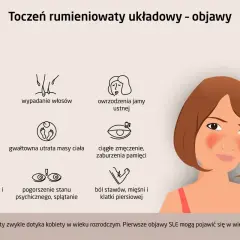 Pierwsze objawy tocznia: ból głowy, wysypka motylkowa, obrzęki, wypadanie włosów, owrzodzenia jamy ustnej, gorączka, utrata masy ciała, zmęczenie, problemy z pamięcią, pogorszenie nastroju, bóle stawów i mięśni.