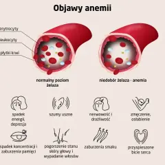 Ilustracja pokazuje porównanie poziomu żelaza we krwi i objawy anemii: bladość skóry, zmęczenie, bóle głowy, szumy uszne i inne.