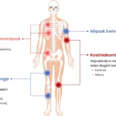 Schemat pokazuje, jak wygląda mięsak: Chrzęstniakomięsak w miednicy, żebrach, łopatkach. Mięsak Ewinga w piszczeli, kościach udowej i ramiennej. Kostniakomięsak w kolanie i łokciu.