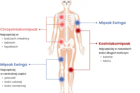 Schemat pokazuje, jak wygląda mięsak: Chrzęstniakomięsak w miednicy, żebrach, łopatkach. Mięsak Ewinga w piszczeli, kościach udowej i ramiennej. Kostniakomięsak w kolanie i łokciu.