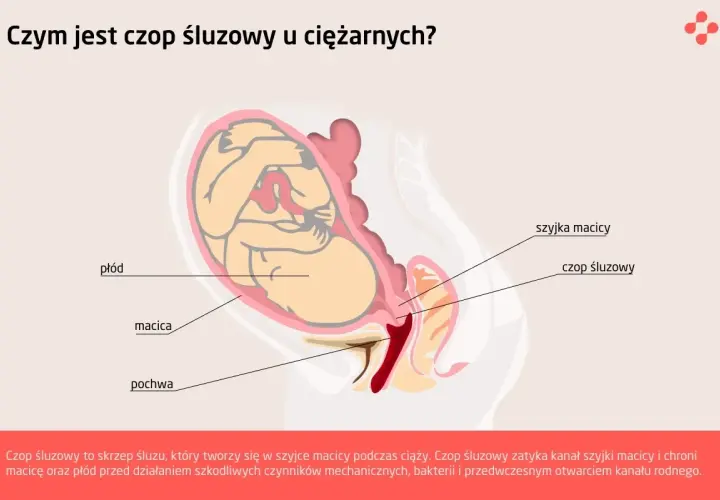 Schemat przedstawia płód w macicy, szyjkę macicy i czop śluzowy zamykający jej kanał, chroniący przed infekcjami.
