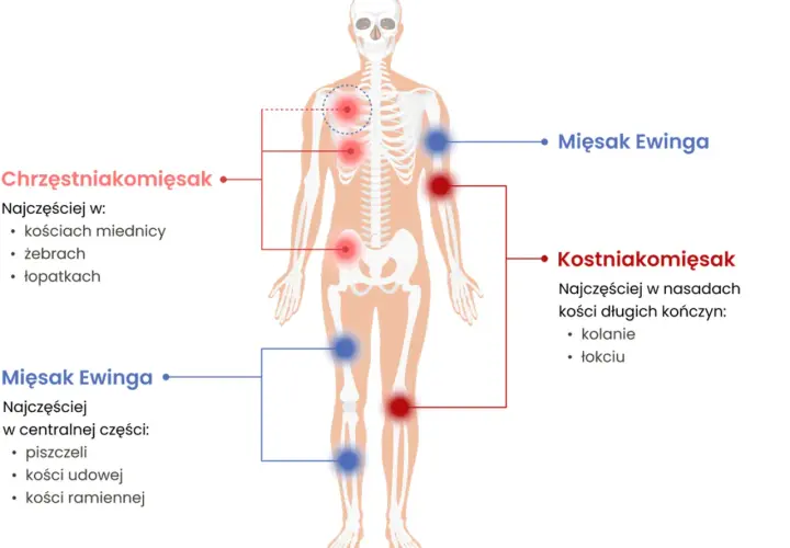 Schemat pokazuje, jak wygląda mięsak: Chrzęstniakomięsak w miednicy, żebrach, łopatkach. Mięsak Ewinga w piszczeli, kościach udowej i ramiennej. Kostniakomięsak w kolanie i łokciu.