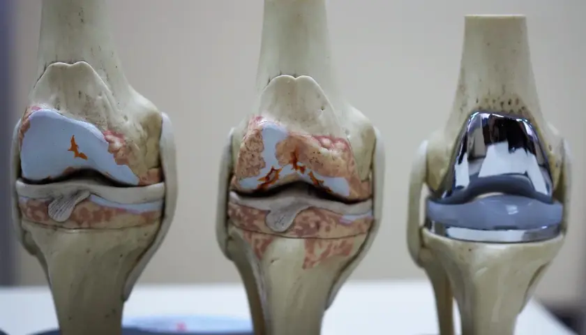 Modele anatomiczne stawów kolanowych: dwa zdrowe, jeden z widoczną endoprotezą kolana.