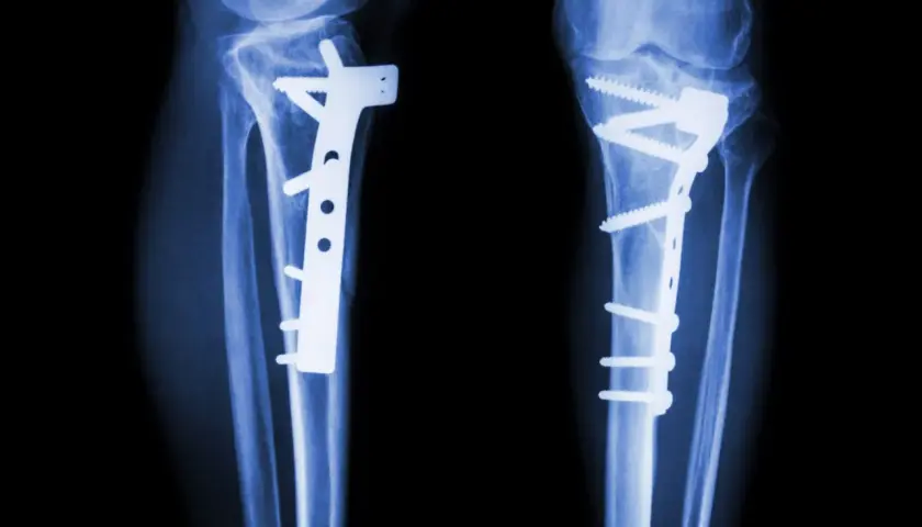 Rentgen nóg po zabiegu osteotomii. Widoczne zespolenia kości płytami i śrubami.