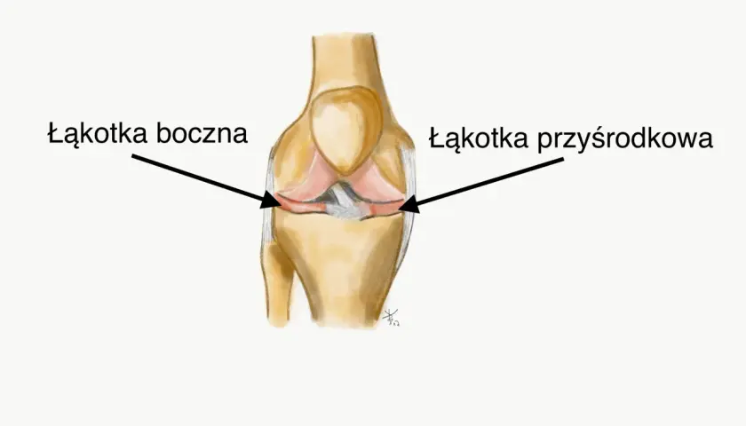 Ilustracja przedstawia staw kolanowy z zaznaczonymi łąkotkami: boczną i przyśrodkową.