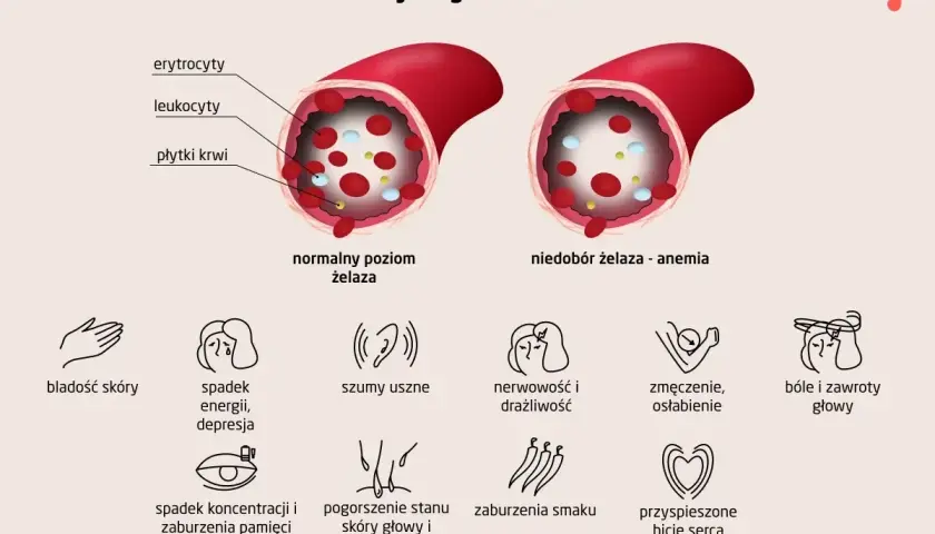 Ilustracja pokazuje porównanie poziomu żelaza we krwi i objawy anemii: bladość skóry, zmęczenie, bóle głowy, szumy uszne i inne.