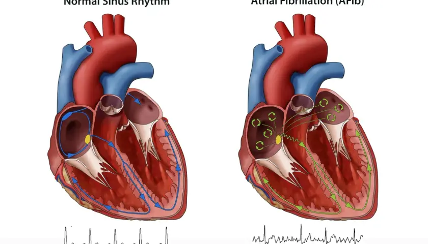 Porównanie prawidłowego rytmu zatokowego serca z migotaniem przedsionków (AFib). Rysunek pokazuje, jak impulsy elektryczne przepływają przez serce. Kardiowersja może pomóc przywrócić prawidłowy rytm.