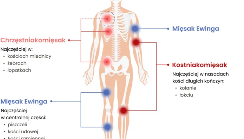 Schemat pokazuje, jak wygląda mięsak: Chrzęstniakomięsak w miednicy, żebrach, łopatkach. Mięsak Ewinga w piszczeli, kościach udowej i ramiennej. Kostniakomięsak w kolanie i łokciu.