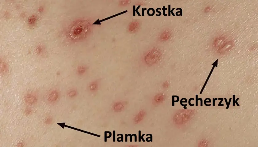 Zmiany skórne charakterystyczne dla ospy wietrznej: plamki, krostki i pęcherzyki.