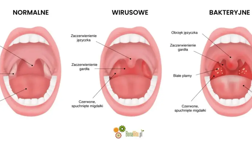 Porównanie gardła: zdrowe, z zaczerwienieniem języczka i gardła przy anginie wirusowej, oraz z białymi plamami przy bakteryjnej.