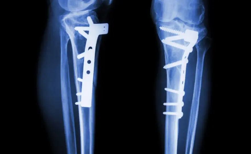 Osteotomia - czy uratuje Twój staw? Pełny przewodnik!