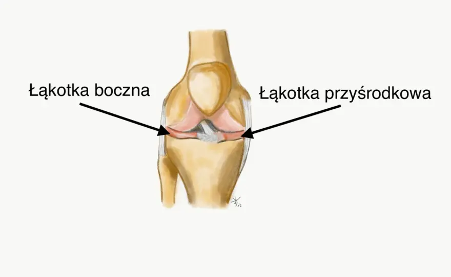 Łąkotka - ból kolana? Nie zawsze operacja! Poznaj leczenie