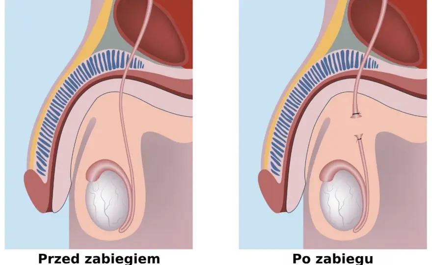Wazektomia odwracalna? Szanse na ciążę i realia zabiegu