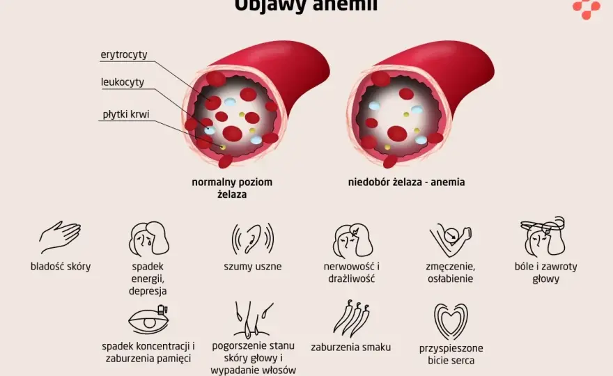 Anemia - objawy, które łatwo przeoczyć. Kiedy do lekarza?
