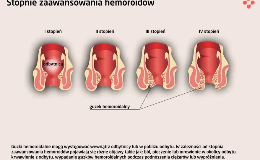 Wypadanie odbytu - Czy to hemoroidy? Objawy i leczenie!