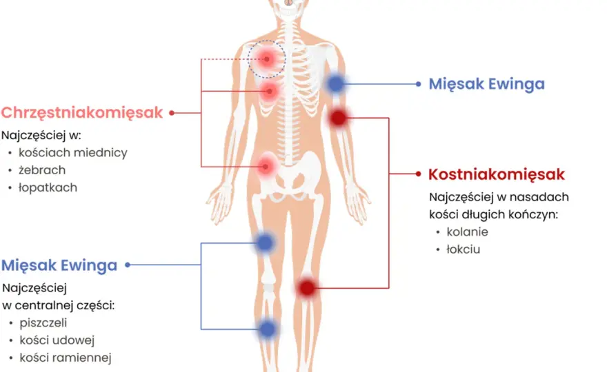 Mięsak na zdjęciach - Jak rozpoznać niepokojące objawy?