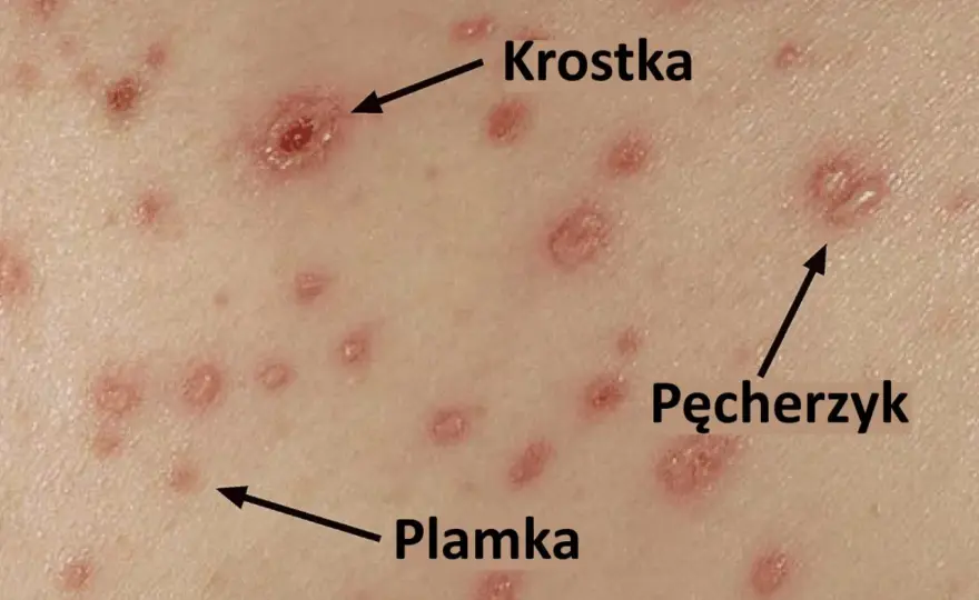 Ospa wietrzna - objawy, etapy i kiedy jest groźna?