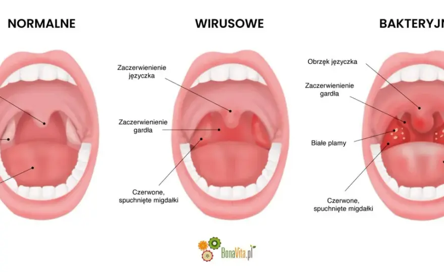 Angina wirusowa - objawy, leczenie i kiedy bez antybiotyku?