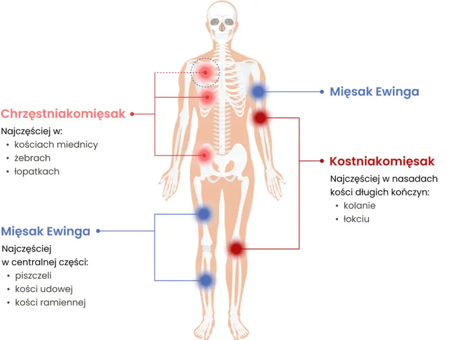 Mięsak na zdjęciach - Jak rozpoznać niepokojące objawy?